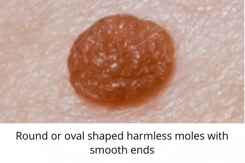 Skin Moles To Worry About A Complete Guide With Skin Moles Pictures