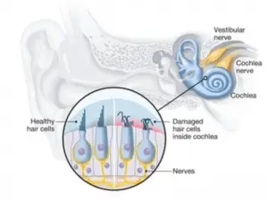 Causes of Tinnitus