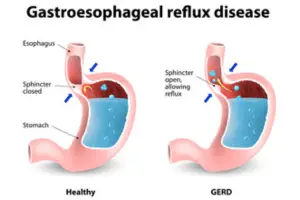 Gastroesophageal Reflux Disease probio lite
