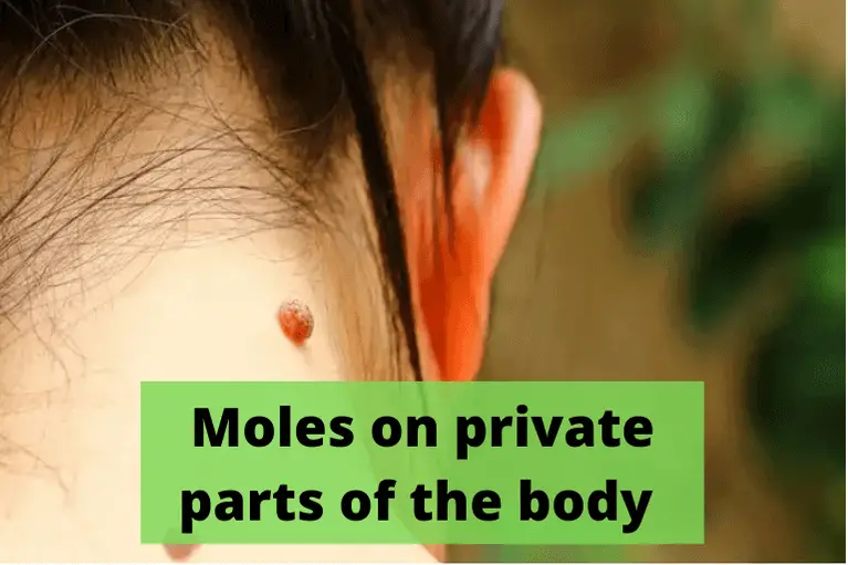 How to remove moles from the private part of the body