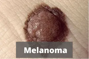 Moles Causes of Melanoma