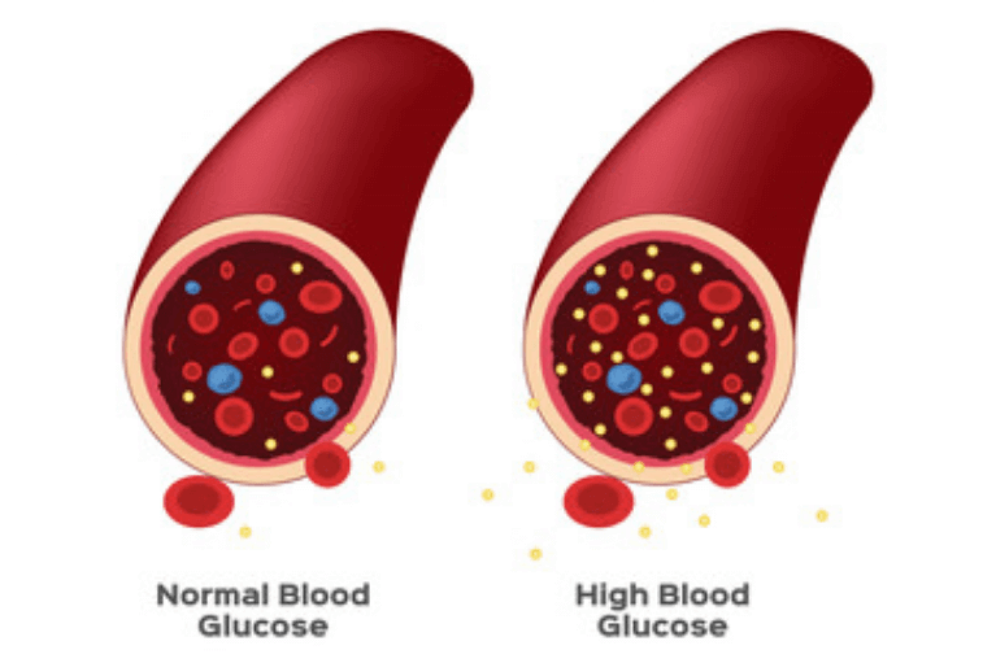 What Happens If Blood Glucose Concentration Is Too High