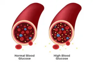 Random blood sugar level