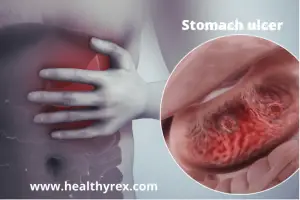 Stomach Ulcers