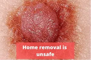 mole home removal is unsafe