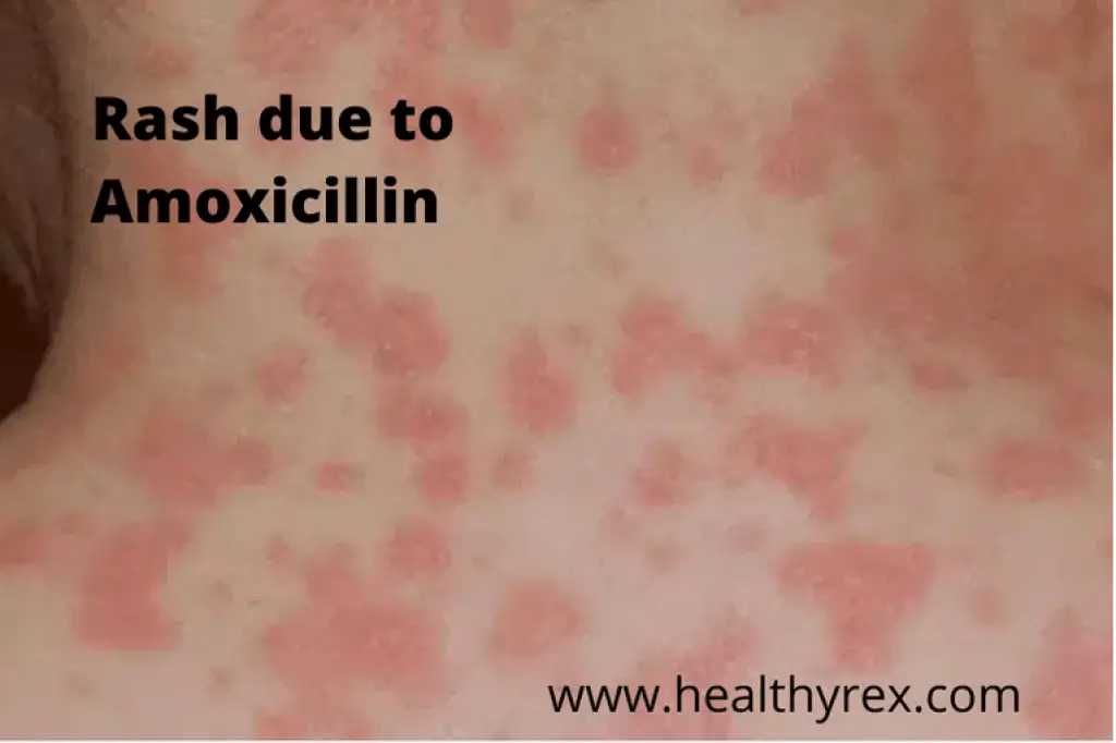 Side Effects Using Amoxicillin 1024x682 