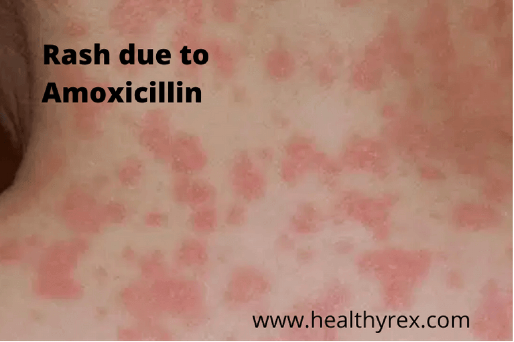 do-amoxicillin-and-alcohol-mix-health-blog