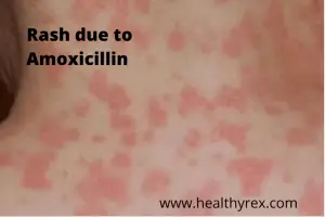 possible side effects using Amoxicillin 