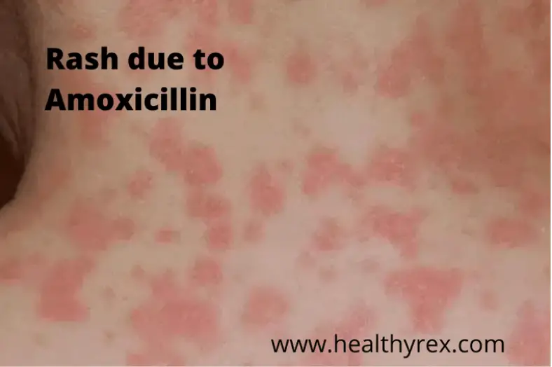can-amoxicillin-raise-your-blood-sugar