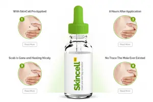 skincell pro mole and skin tag remover