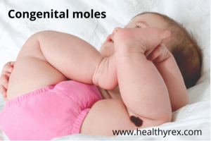 Congenital moles on baby