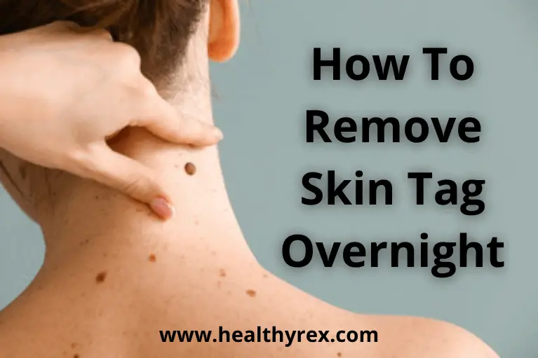 How To Remove Skin Tag Overnight