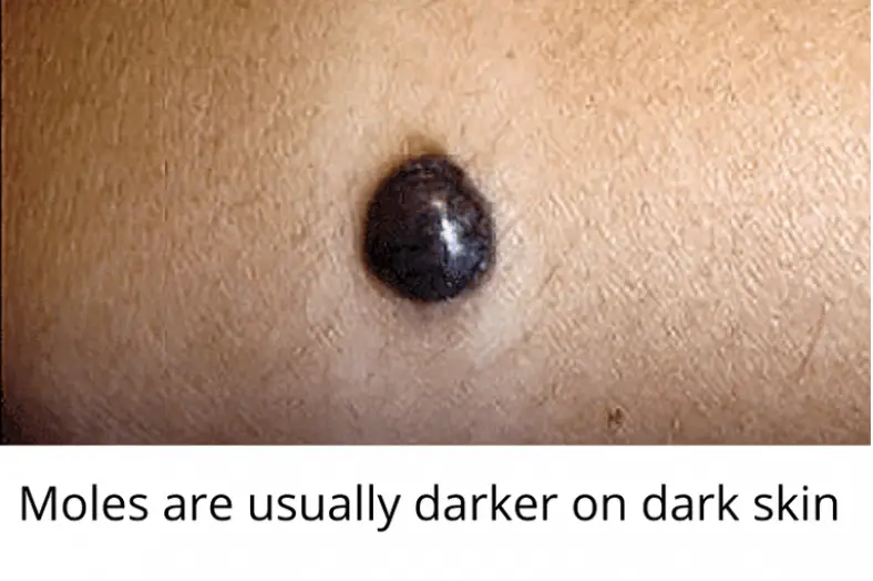 Skin Moles to Worry About A Complete Guide With Skin Moles Pictures