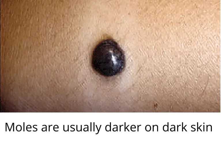 Skin Moles to Worry About A Complete Guide With Skin Moles Pictures