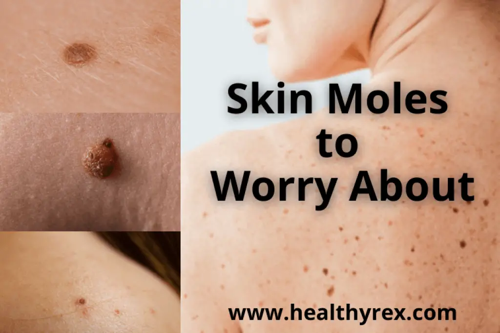 skin moles to worry about