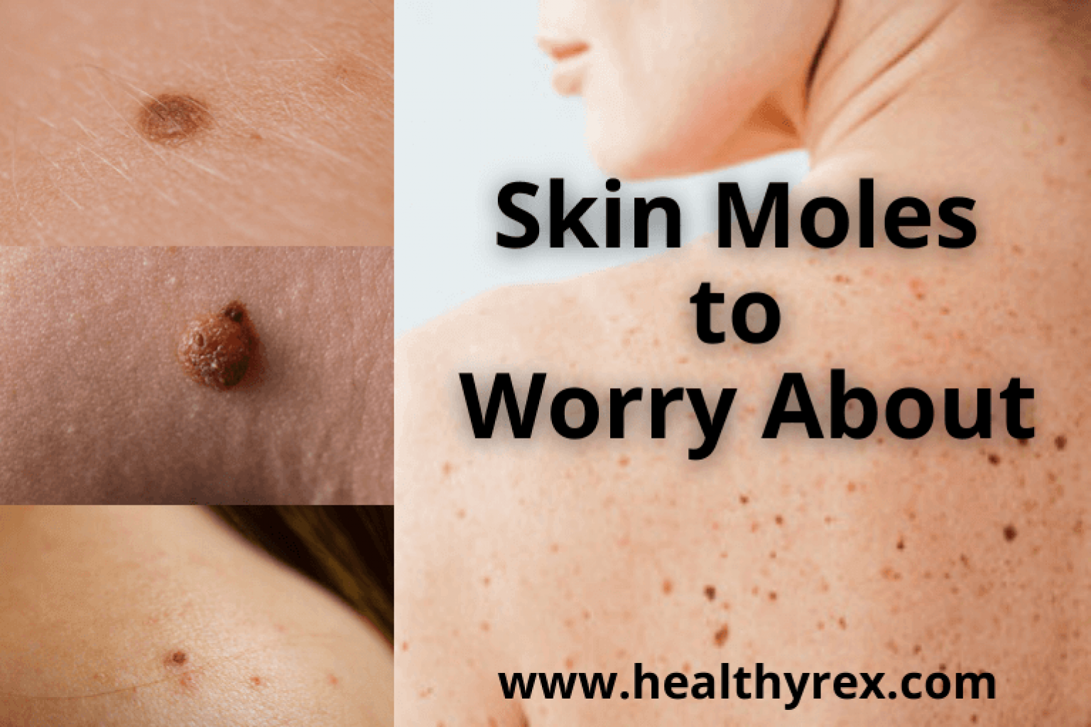 skin-moles-to-worry-about-a-complete-guide-with-skin-moles-pictures