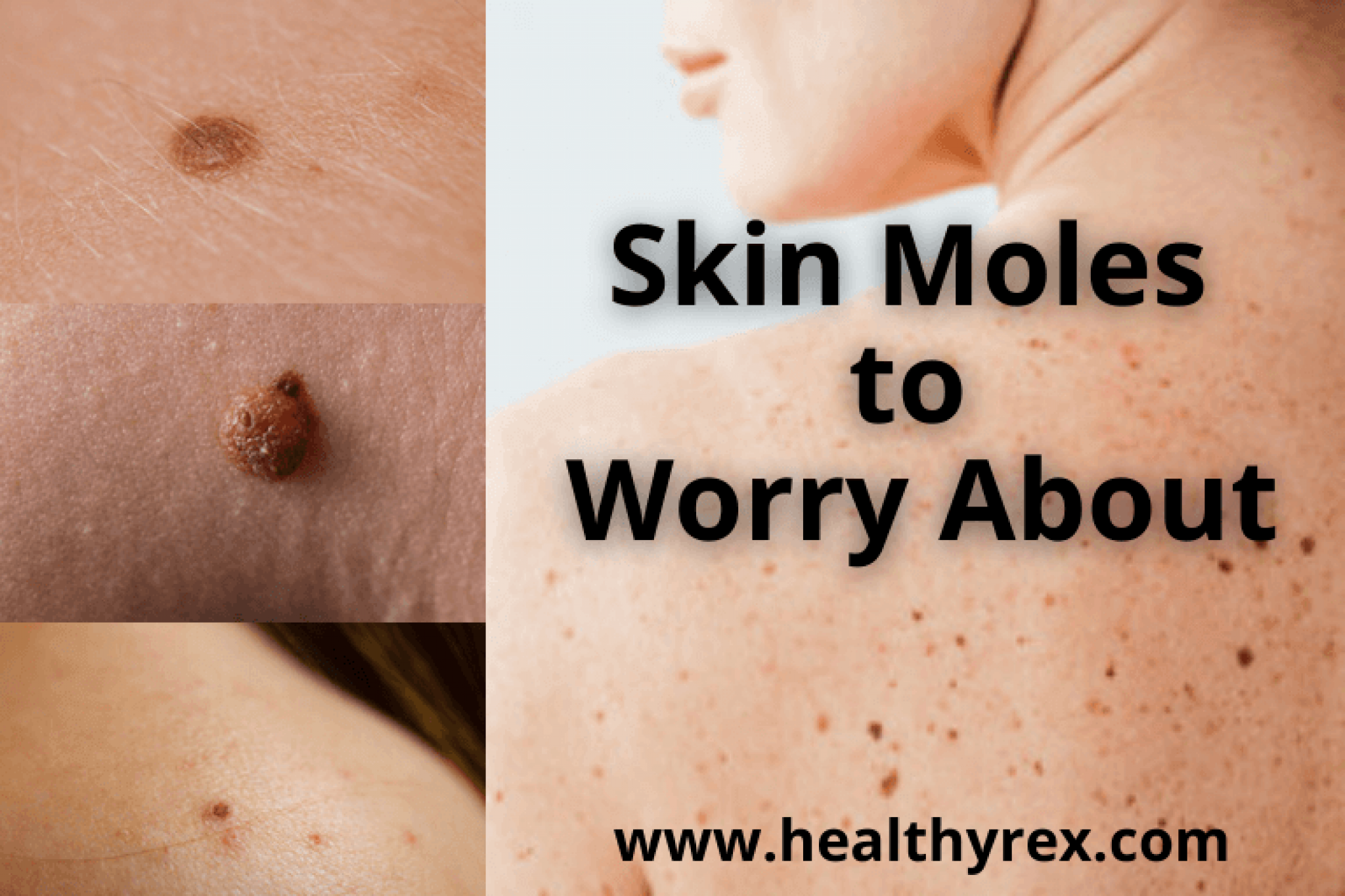 Skin Moles To Worry About A Complete Guide With Skin Moles Pictures