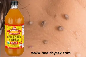 apple cider vinegar skin tag removal