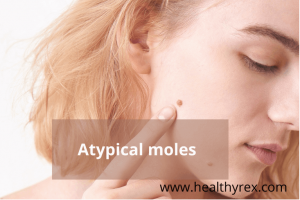Atypical moles
