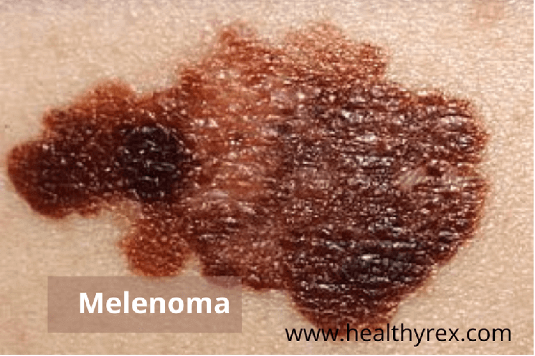 Is Melanoma Always A Mole