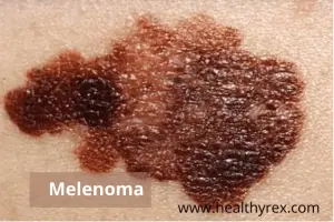melanoma moles
