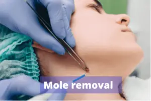 Mole removal