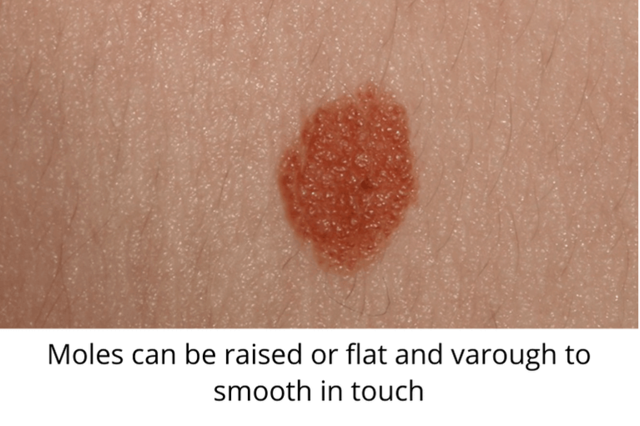 Skin Moles to Worry About A Complete Guide With Skin Moles Pictures