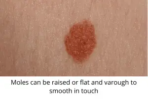 moles can be raised or flat and varough to smooth in touch