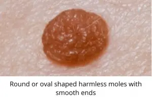 round or oval shaped harmless moles with smooth ends