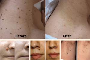 Derma Correct Skin Tag Remover