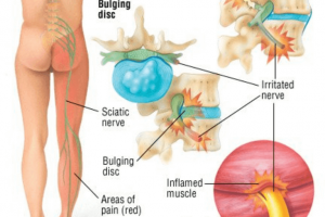 What Are The Causes Of Nerve Pain In The Legs?