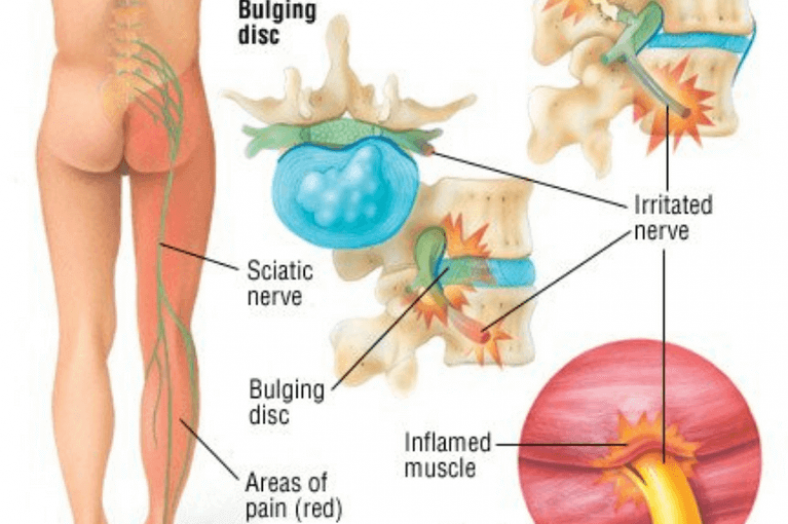 nerve-pain-in-the-leg-causes-symptoms-treatment-exercise