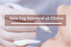 Skin Tag Removal at Clinics