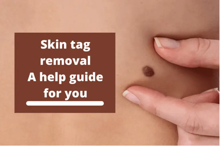 Skin Tag Removal A Help Guide For You