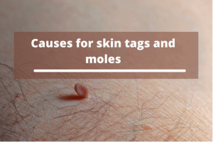 What are the reasons for skin tags and moles?