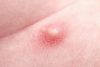 Pimple-like Bump on The Clitoral Hood