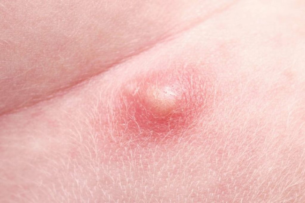 Pimple-like Bump on The Clitoral Hood