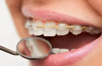 Can I Get a Cavity Filled with Braces on My Teeth?