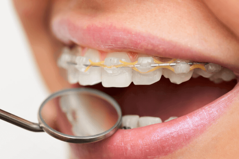 Can I Get a Cavity Filled with Braces on My Teeth?