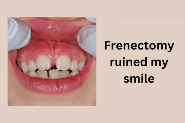 Frenectomy ruined my smile