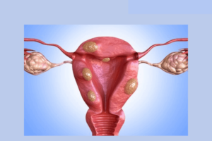 Causes of sudden fibroid growth