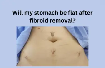 Will my stomach be flat after fibroid removal?