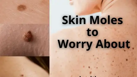 Skin Moles to Worry About – A Complete Guide With Skin Moles Pictures
