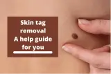 Skin Tag Removal – A Help Guide For You